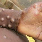 Explained: What Is Monkeypox? UN Confirms Sexual Spread Of The Disease In Congo