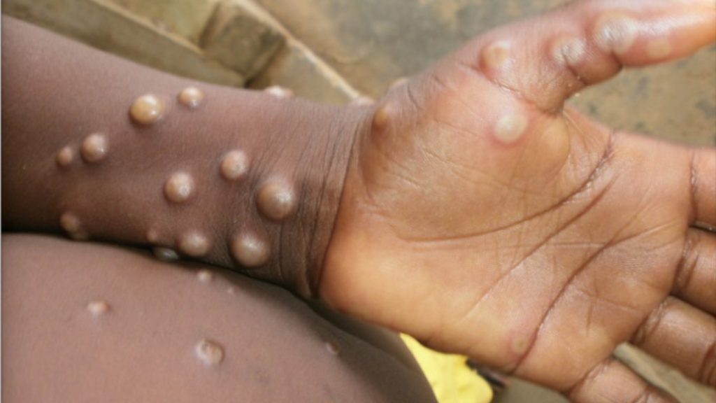 Explained What Is Monkeypox UN Confirms Sexual Spread Of The Disease In Congo