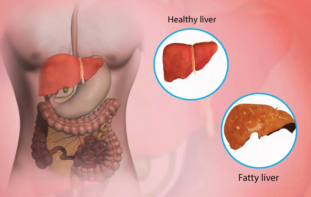 Fatty liver disease